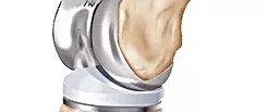 亮抛光人工膝关节解剖图